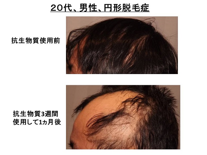円形脱毛症　病院""